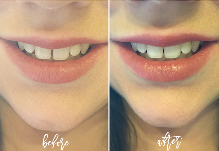 Crest Whitestrips Before and After